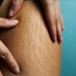 4 Cara Menghilangkan Stretch Mark Dengan Cepat Tradisional