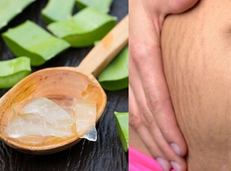 4 Cara Menghilangkan Stretch Mark Dengan Cepat Tradisional