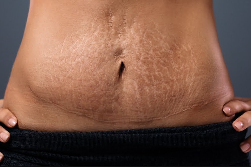 4 Cara Menghilangkan Stretch Mark Dengan Cepat Tradisional