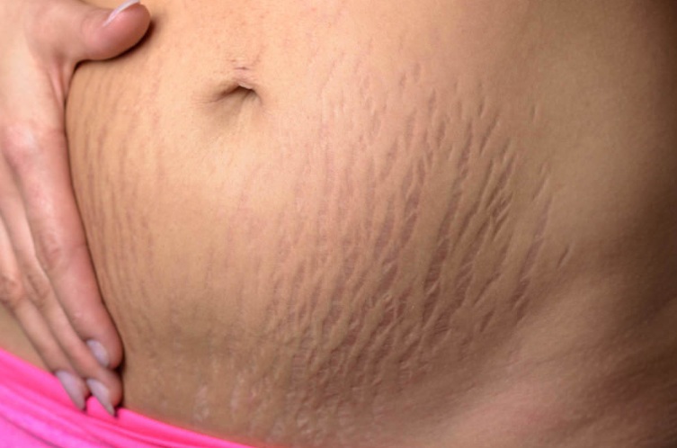 4 Cara Menghilangkan Stretch Mark Dengan Cepat Tradisional