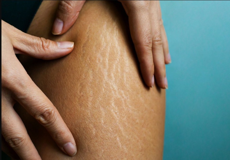 4 Cara Menghilangkan Stretch Mark Dengan Cepat Tradisional
